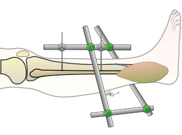 External Fixation Surgery