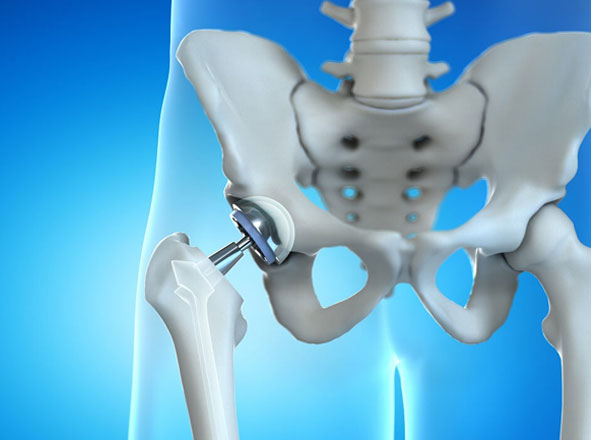 Total Hip Replacement