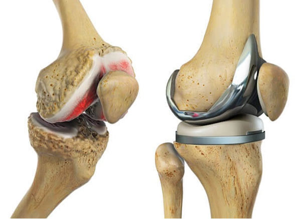 Total Knee Replacement