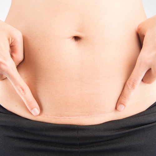 C-Section