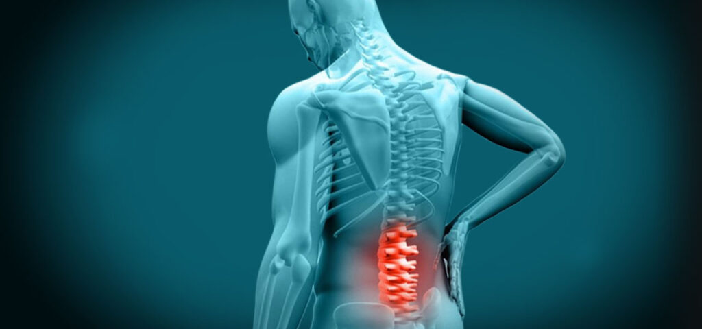 What is Slipped Disc? What causes it and how can it be Treated